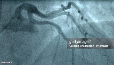 183 Heart Angiogram Stock Photos, High-Res Pictures, and Images - Getty ...