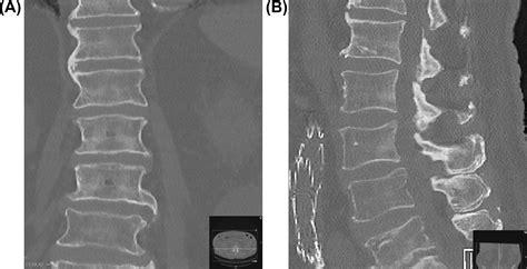 Disc Space Narrowing And Osteophytes Clinical Tree