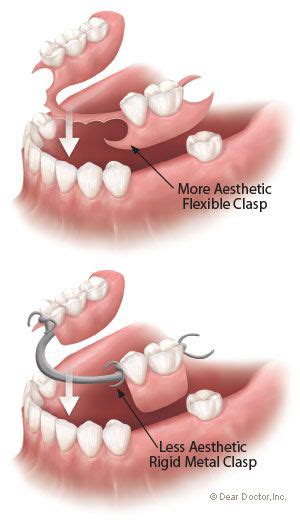 Flexible Dentures Elite Dental Care