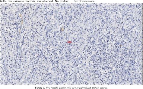 Figure 3 From Proximal Epithelioid Sarcoma Of The Vulva A Rare