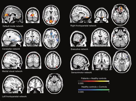 Resting State Functional Mri Findings In Orthostatic Tremor Resting