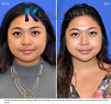 Asian Rhinoplasty Before And After Gallery Dr Kolstad San Diego Facial Plastic Surgeon