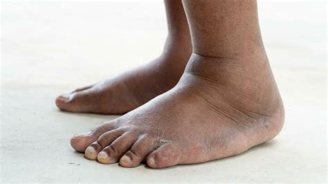 Foot Swelling Stock Photos, Images and Backgrounds for Free Download