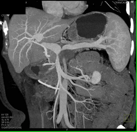 Pancreatic Cancer Infiltrates The Pancreatic Bed Portal Venous And