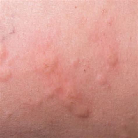 8 Common Types Of Rashes Types Of Rashes Rashes Common Skin Rashes Images