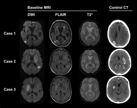 Exemplary Scans From 3 Ischemic Stroke Patients Using M Open I