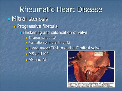 Ppt Valvular Stenosis Powerpoint Presentation Free Download Id 4745184