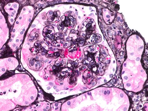 Membranoproliferative Glomerulonephritis