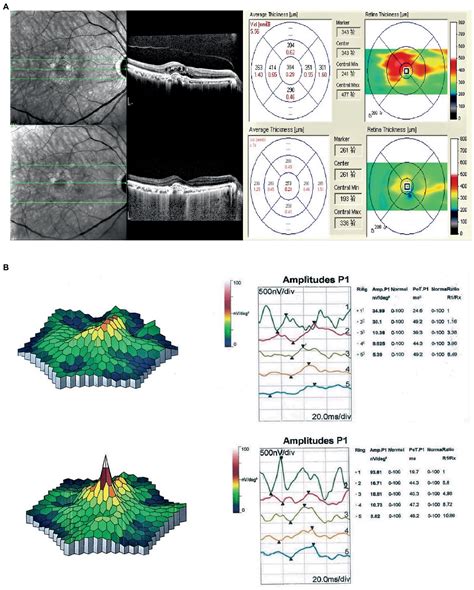 Frontiers Spectral Domain Optical Coherence Tomography Combined With