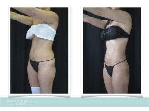 Pin On Vaser Liposuction 4d Lipo