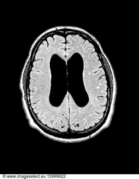 MRI Communicating Hydrocephalus (NPH) MRI Communicating Hydrocephalus (NPH),abnormal enlargement ...