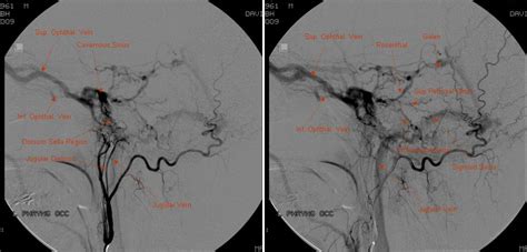 Ascending Pharyngeal Artery | neuroangio.org