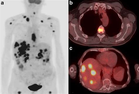 What Is A Pet Ct Scan For Cancer