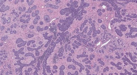 Lobular Carcinoma In Situ Archives Ottawa Atlas Of Pathology