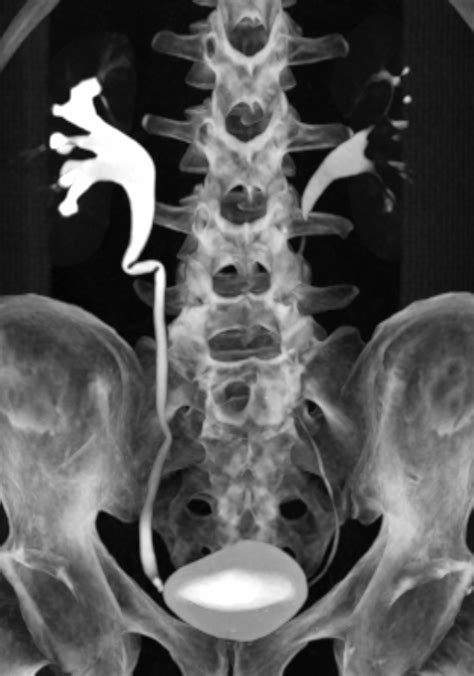 Retroaortic Left Renal Vein Type I Image