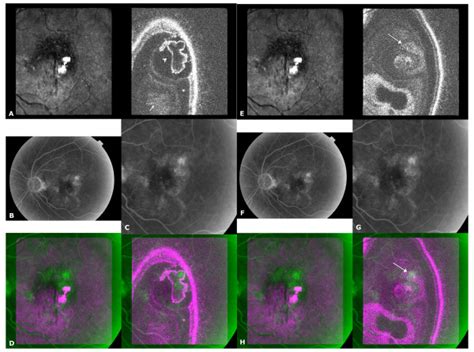 Retinal Angiomatous Proliferation Rap A C Scan Taken At Midretina