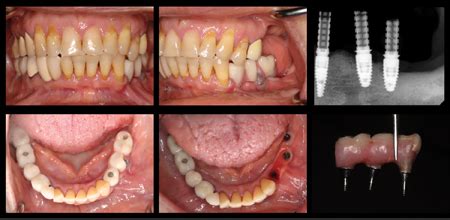 Assessment Of The Restorability Of A Malpositioned Dental Implant With