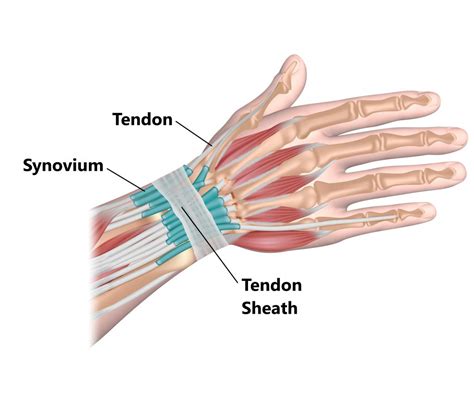 Tenosynovitis Vs Tendonitis