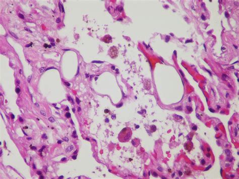 Fat Embolism Atlas Of Pulmonary Pathology Flickr