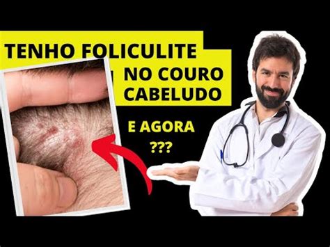 QUAL MELHOR TRATAMENTO CONTRA FOLICULITE NO COURO CABELUDO FOLICULITE