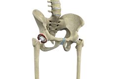 Total Hip Replacement Surgery Boston Ma Hip Arthritis Waltham