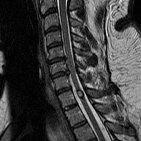 Spinal Cord Cavernous Malformation Radsource