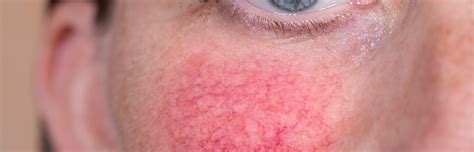 Redness And Sensitivity Skin Concern