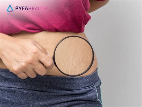 Beragam Cara Menghilangkan Stretch Mark Dan Pencegahannya