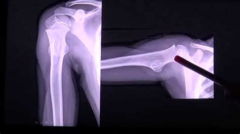 Osteochondroma Or Osteocartilaginous Exostosis Tumor In Ct Scan By