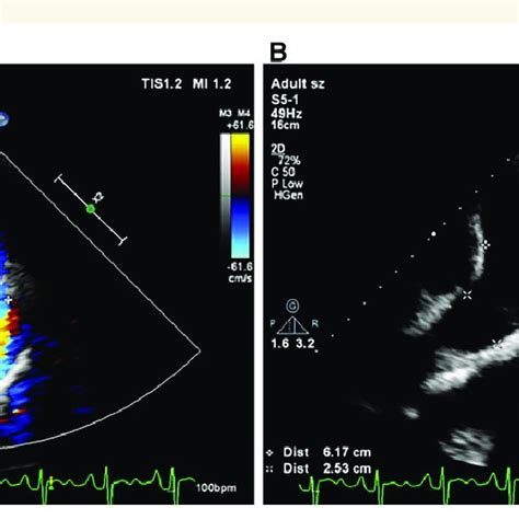 Echocardiography Showing Patent Ductus Arteriosus And Left Pulmonary Download Scientific