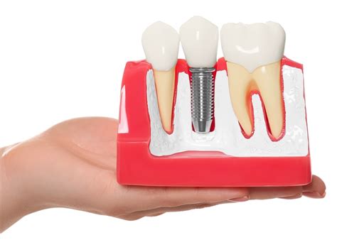 How Dental Implants Can Transform Your Smile