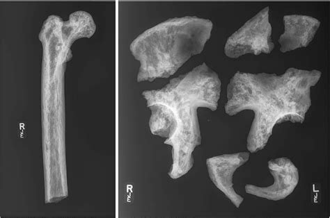 Radiographs Of The Right Proximal Femur And Pelvic Fragments Showing