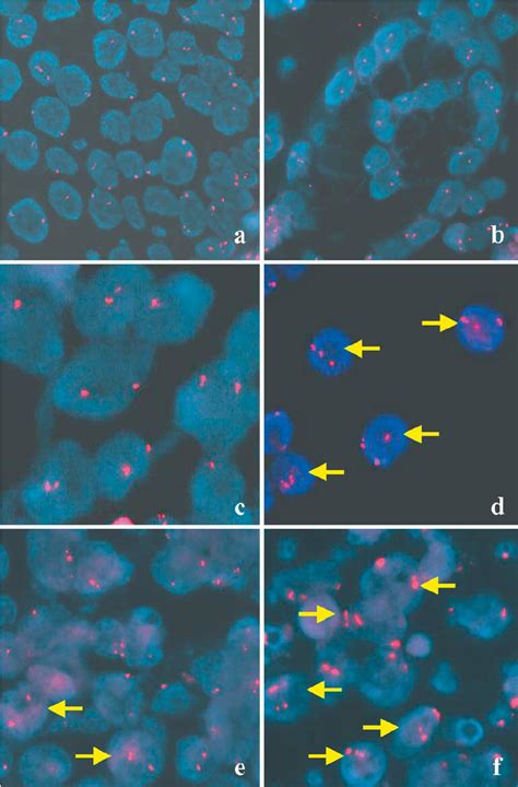 Fluorescence In Situ Hybridisation Analysis Of Cep Probe And The