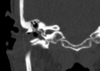 Temporal Bone Fracture-CT - Sumer's Radiology Blog