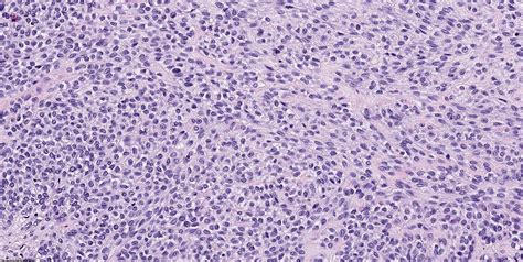 Pathology Outlines Myoepithelial Carcinoma