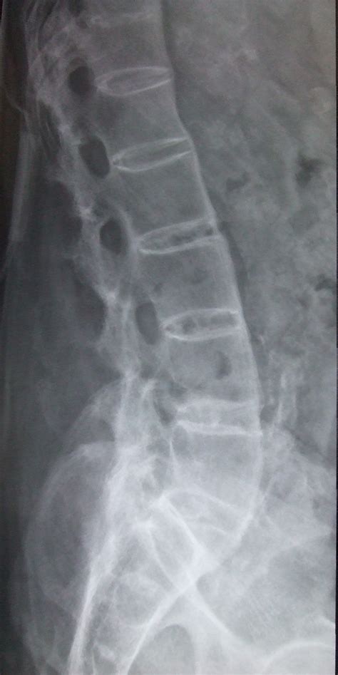 File:Ankylosing spondylitis lumbar spine.jpg