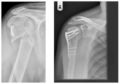 Two-part fracture of the surgical neck with subsequent internal fixation. | Download Scientific ...