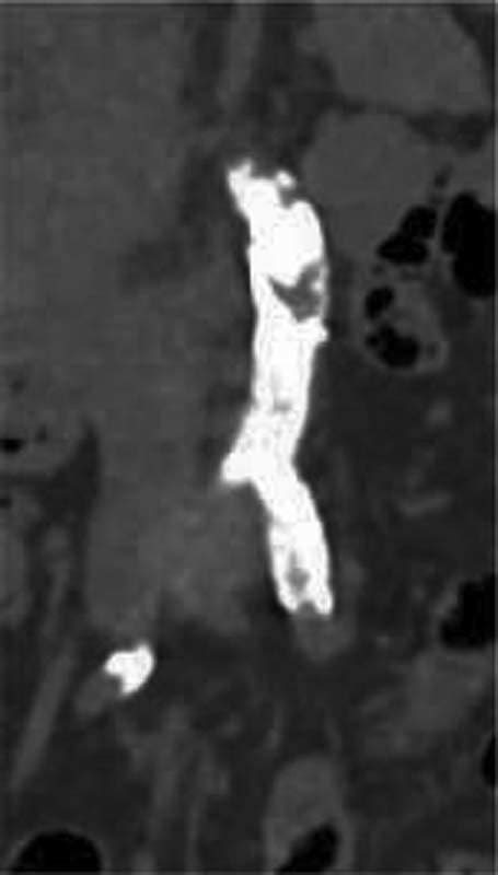 Plain Computed Tomography Of Abdominal Aorta Suggestive Of Diffuse