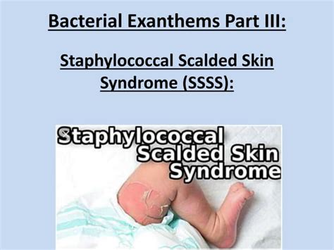 Staphylococcal Scalded Skin Syndrome Made Very Easy