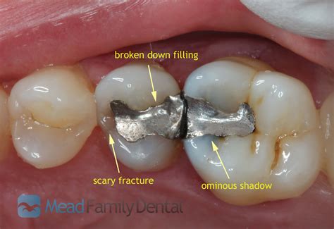 diy cavity filling