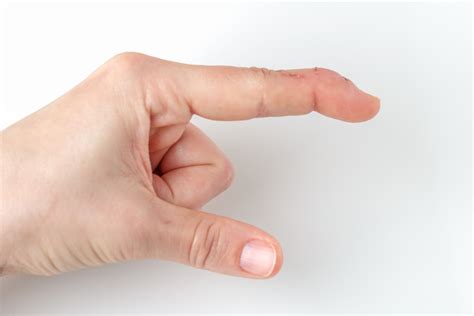 How To Know If You Have A Mallet Finger