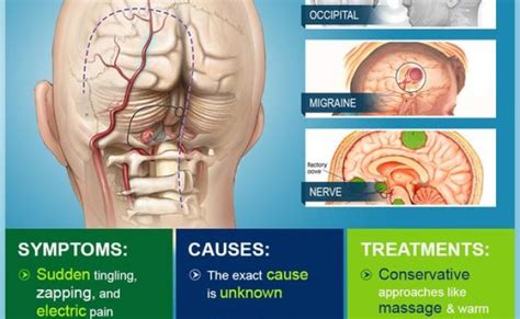 Occipital Neuralgia Explained Neuralgia Occipital Neuralgia Patient Otosection