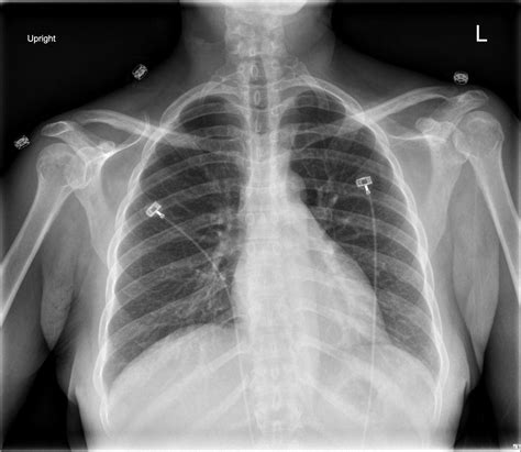 Cervical Ribs Radiology Case Cervical