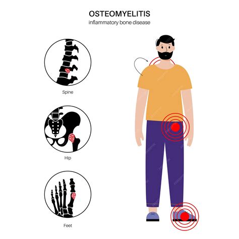 Enfermedad De Osteomielitis En Adultos Casos Comunes Huesos Infectados