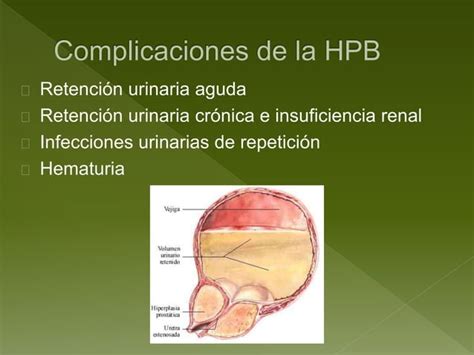 Hiperplasia Prost Tica Benigna C Ncer De Pr Stata Y Urolitiasis Ppt