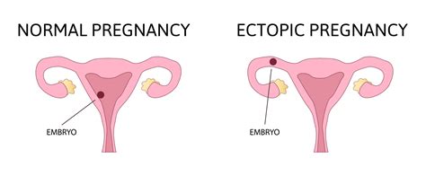 Signs Of An Ectopic Pregnancy This Little Nest