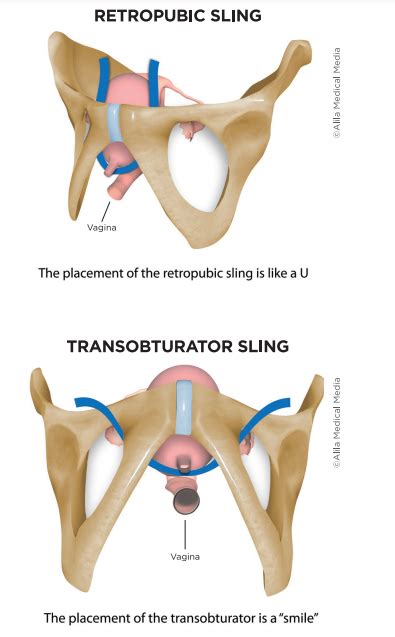 Mid-urethral Sling for Stress Urinary Incontinence - Brazosport Women's ...