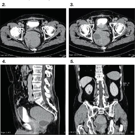 Figure 2 5 From Transperitoneal Laparoscopic Treatment For Recurrence Of A Giant Multilocular