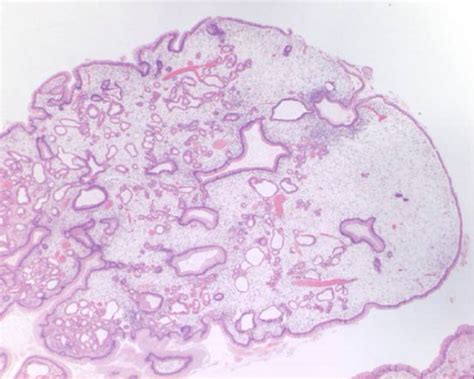 Juvenile Polyp