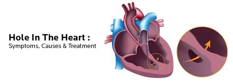 Understanding the Impact of A Hole In The Heart - BMB